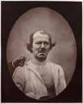 Figure 51  droite, contraction partielle de l'lvateur commun de l'aile du nez et de la lvre suprieure mcontentement, mauvaise humeur  gauche, repos by Guillaume-Benjamin-Amand Duchenne (de Boulogne) (French, 1806–1875) - Classic Art canvas print