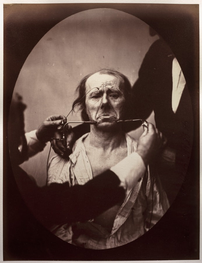 Figure 45 Contraction lectrique forte des triangulaires des lvres et des sourciliers douleur et dspoir by Guillaume-Benjamin-Amand Duchenne (de Boulogne) (French, 1806–1875) - Classic Art canvas print
