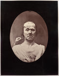 Figure 7 tude du mchanisme et de l'expression du muscle frontal chez un vieillard  droit, attention  gauche, repos by Guillaume-Benjamin-Amand Duchenne (de Boulogne) (French, 1806–1875) - Classic Art canvas print
